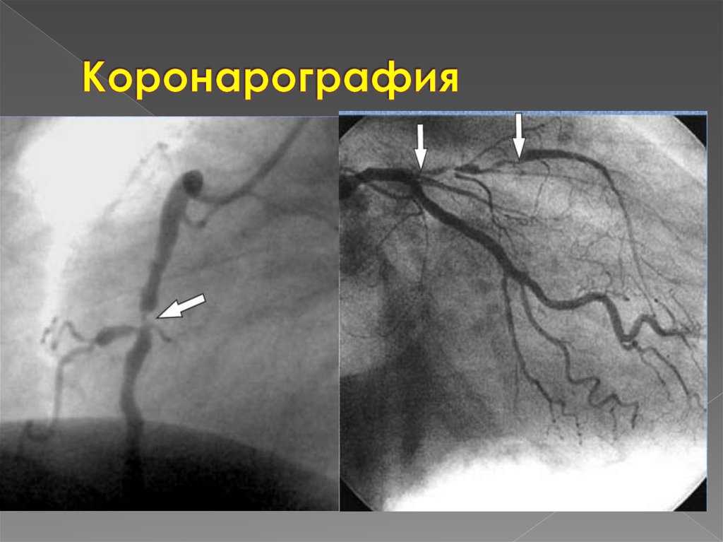 Коронарография сосудов сердца: что это такое и как ее проводят, подготовка