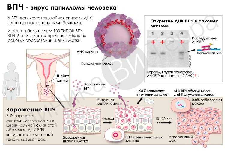 Вирус папилломы человека у мужчин