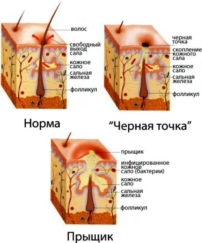 Гормональное акне у женщин