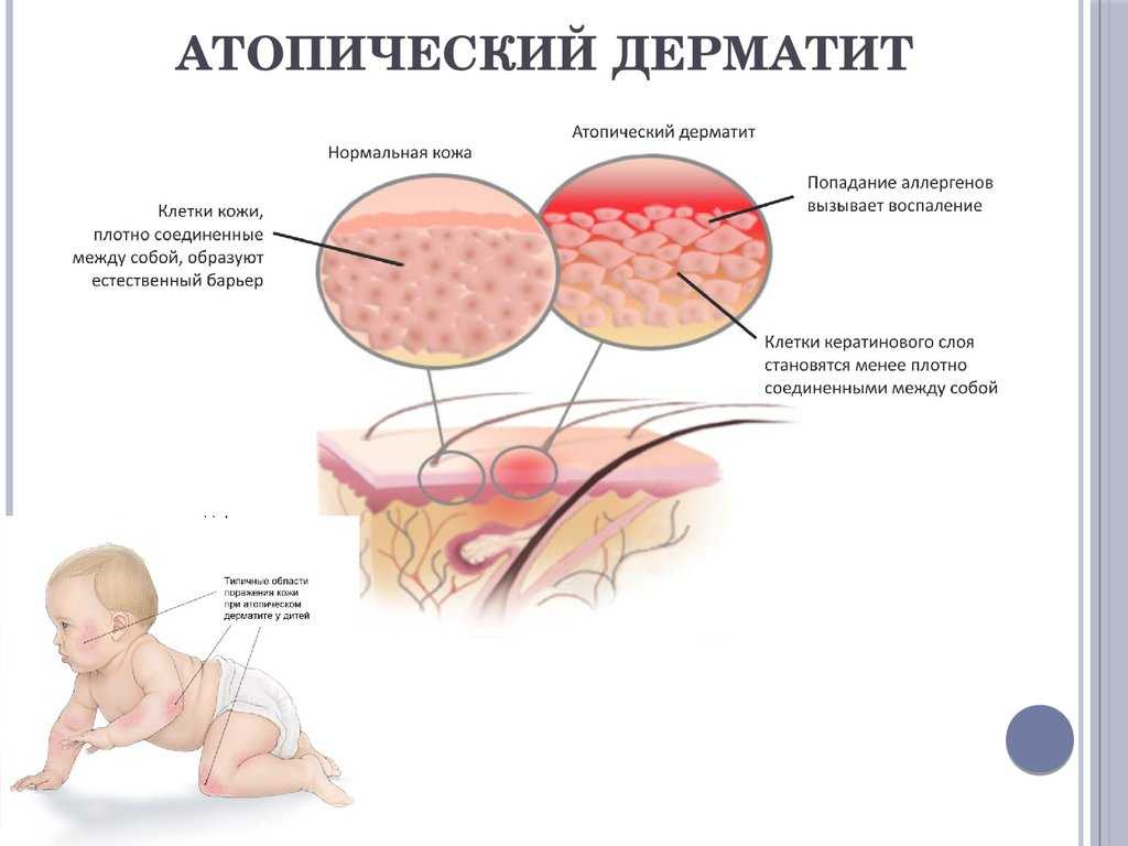 Лекарства от аллергии для детей, безопасные средства, обор лучших
