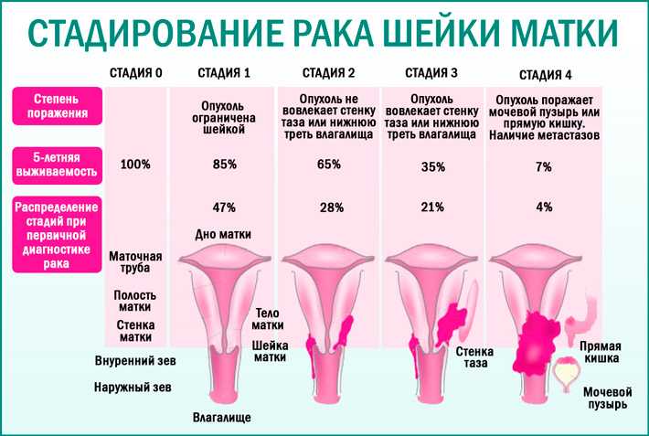 Через сколько матка. Стадии развития опухоли шейки матки. Ранние симптомы онкологии шейки матки. Степени онкологии шейки матки. РВК шейки матки стадии.