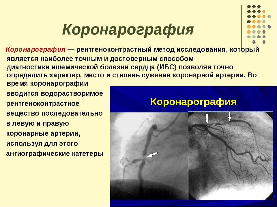Коронарография, коронарное стентирование