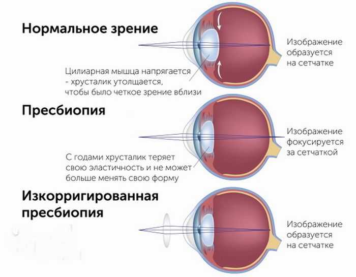 Почему ухудшается зрение и что с этим делать