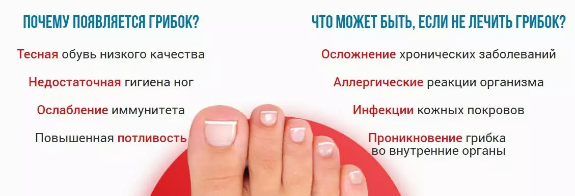 Онихомикоз
