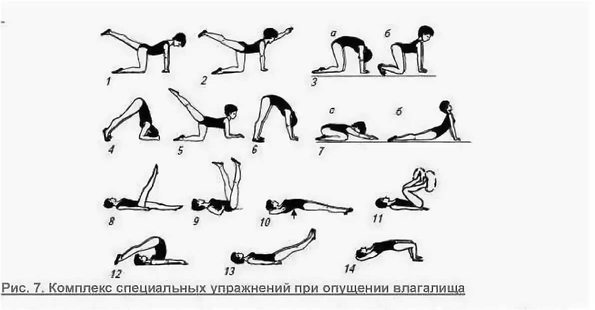 Пессарий при опущении матки — лечение пролапса без операции