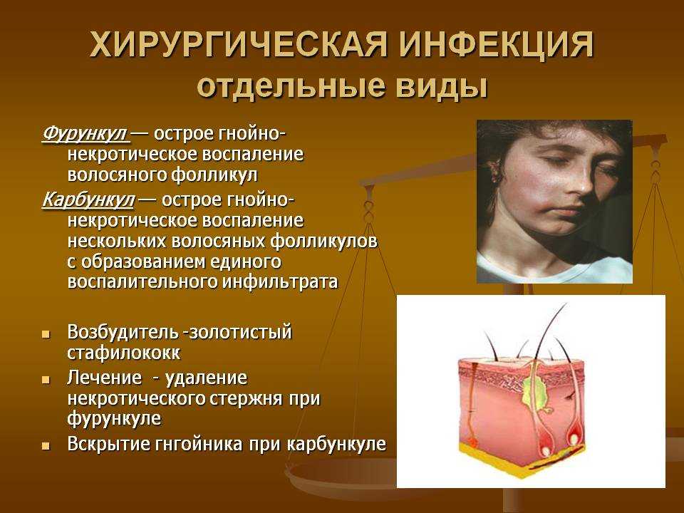 Что такое фурункул и как лечить фурункул, стоит ли это делать в домашних условиях?