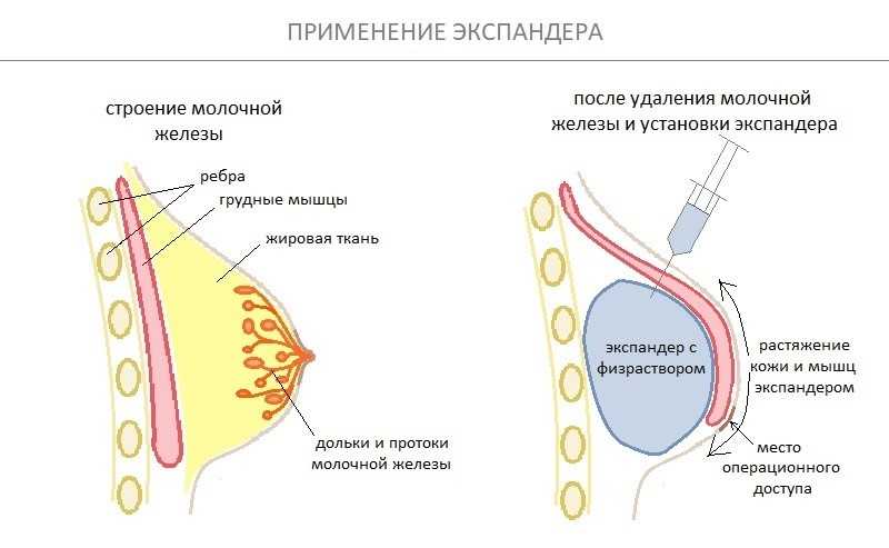 Удаление рака молочной железы