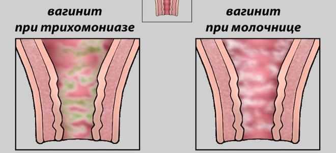 Интимное восстановление после родов