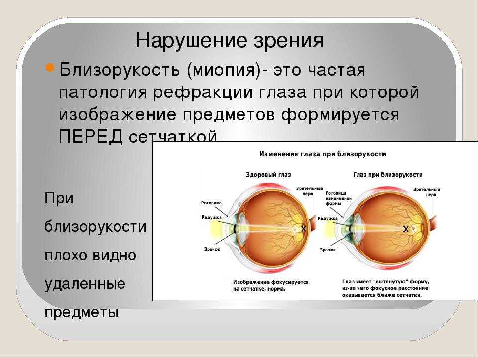 Причины и лечение близорукости у детей