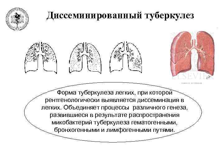 Диссеминированный туберкулез легких картинки