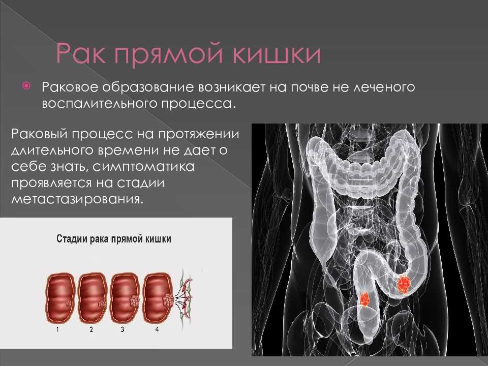 Рак прямой кишки рисунок