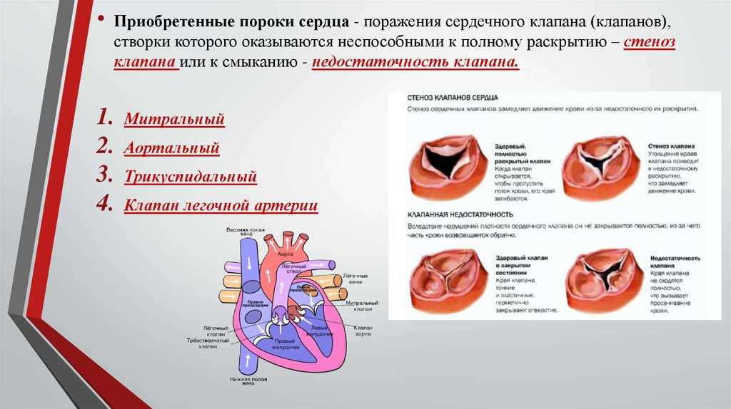 Поражение митрального клапана. Классификация пороков митрального клапана. Механизм формирования приобретенных пороков сердца. Приобретенные пороки аортального клапана. Перечислите основные виды приобретенных пороков сердца..