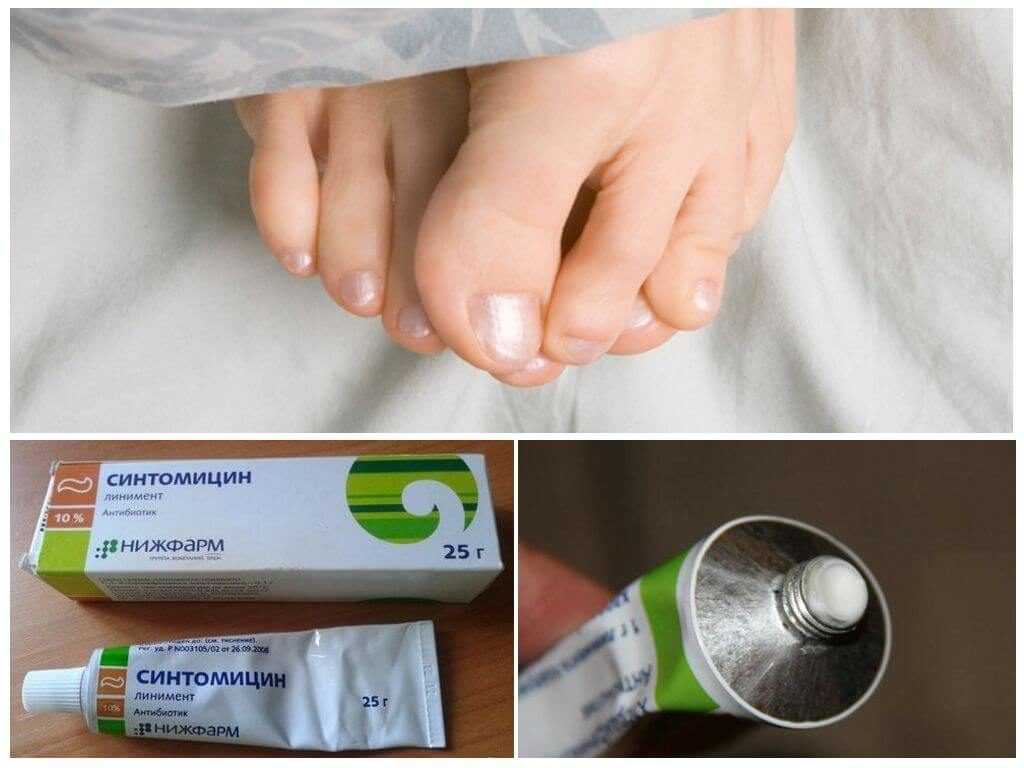 Онихомикоз