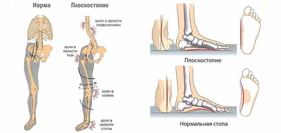 Лечение плоскостопия у детей. консультация врача ортопеда - доктор позвонков