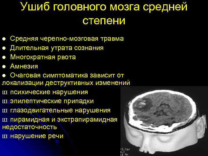 Сотрясение головного мозга: симптомы и лечение, степени тяжести и последствия