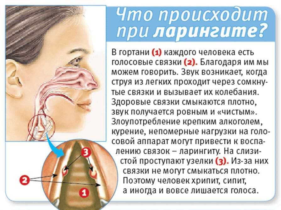 Острый ларингит: воспаления гортани и голосовых связок