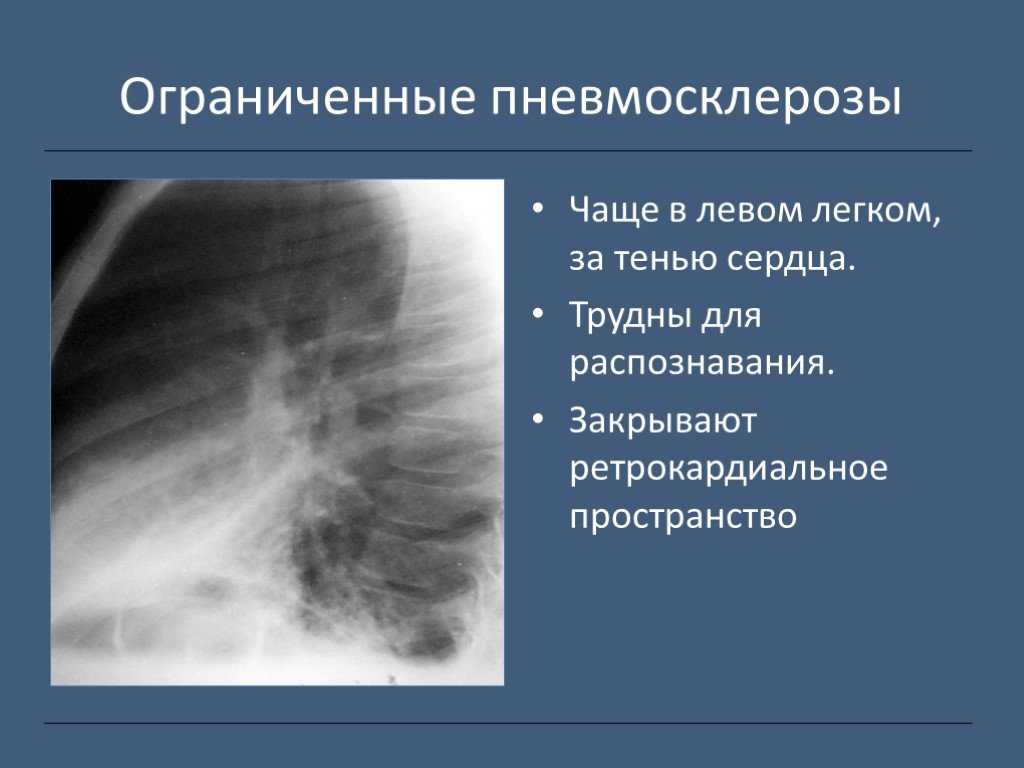 Легочный рисунок с признаками пневмосклероза что это значит