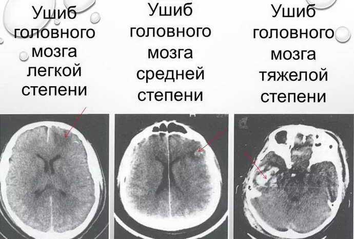 Сотрясение головного мозга