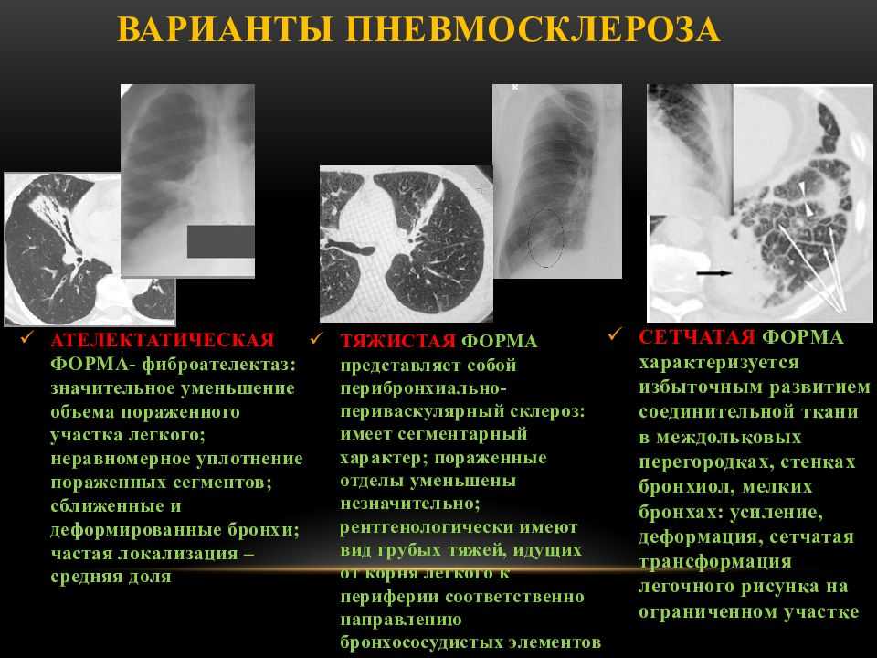 Легочный рисунок с признаками пневмосклероза что это значит у женщин