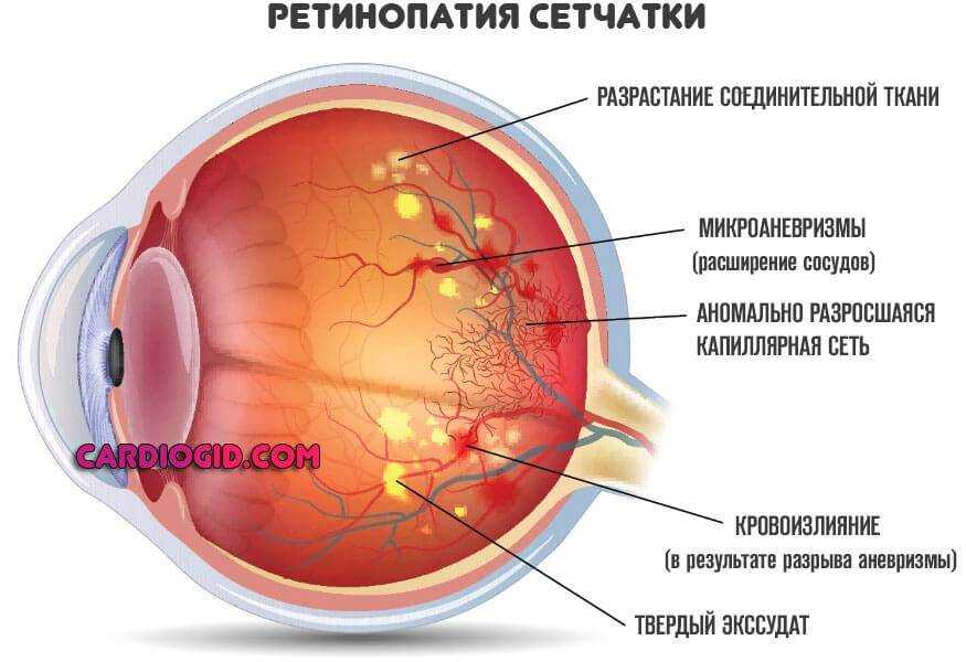 Лопнул сосуд в глазу у ребенка - причины, особенности у грудничков