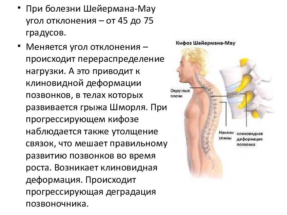Поясничный кифоз, кифозирование поясничного отдела позвоночника: что это такое?