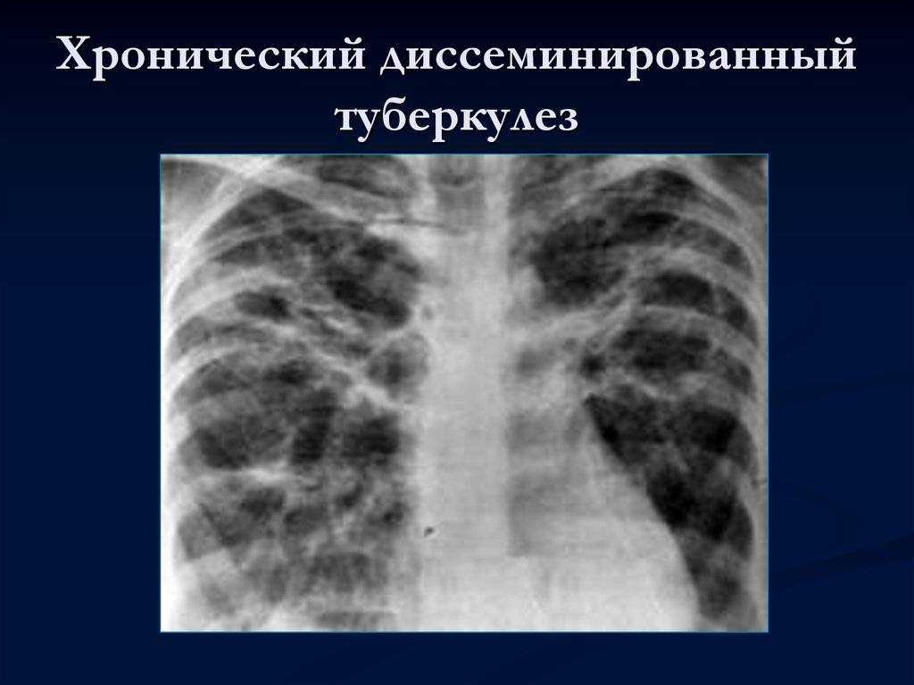 Диссеминированный туберкулез фаза инфильтрации. Милиарный диссеминированный туберкулез рентген. Очаговый и диссеминированный туберкулез. Острый диссеминированный туберкулез. Хронический диссеминированный туберкулез рентген.