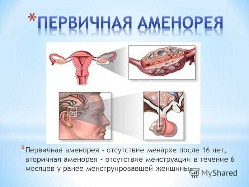 Аменорея симптомы у женщин