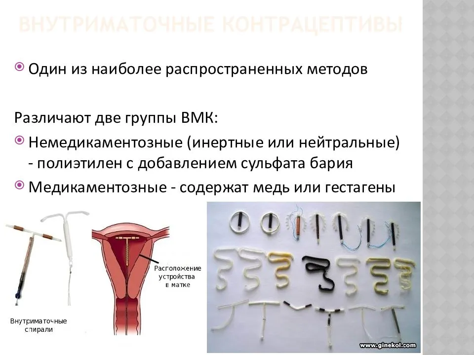 Ученые описали редкое осложнение использования внутриматочной спирали