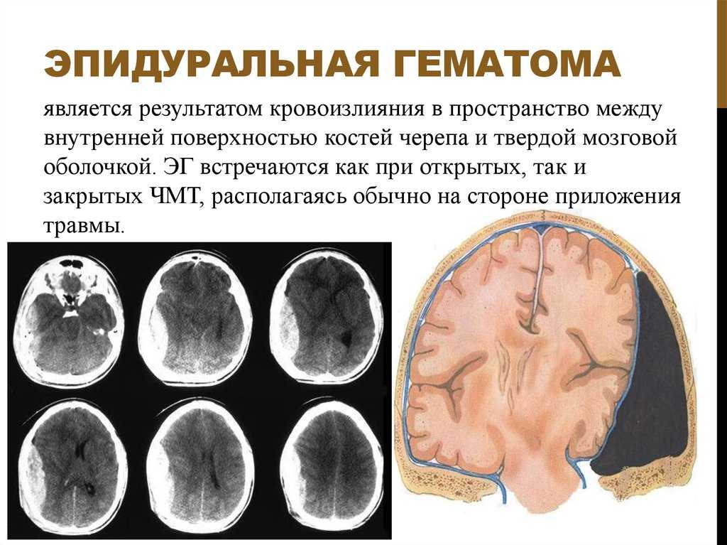 Гематомы – 6 случаев, когда они могут быть опасным симптомом | evolutis clinic | дзен