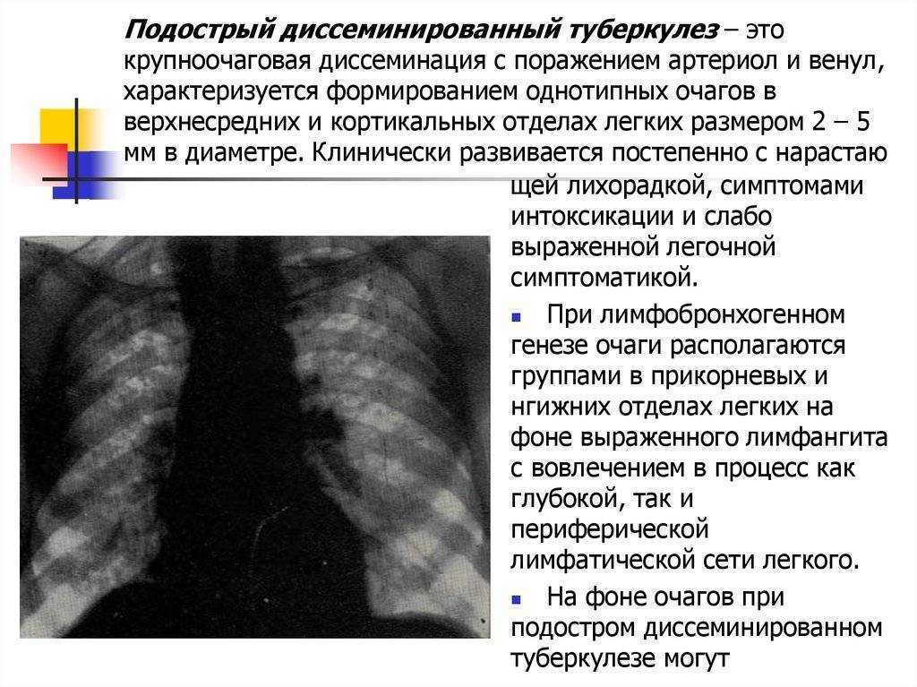 Формы диссеминированного туберкулеза. Диссеминированный туберкулез в фазе инфильтрации. Рентгенологические симптомы диссеминированного туберкулеза. Подострый диссеминированный туберкулез. Острый диссеминированный туберкулез рентген.