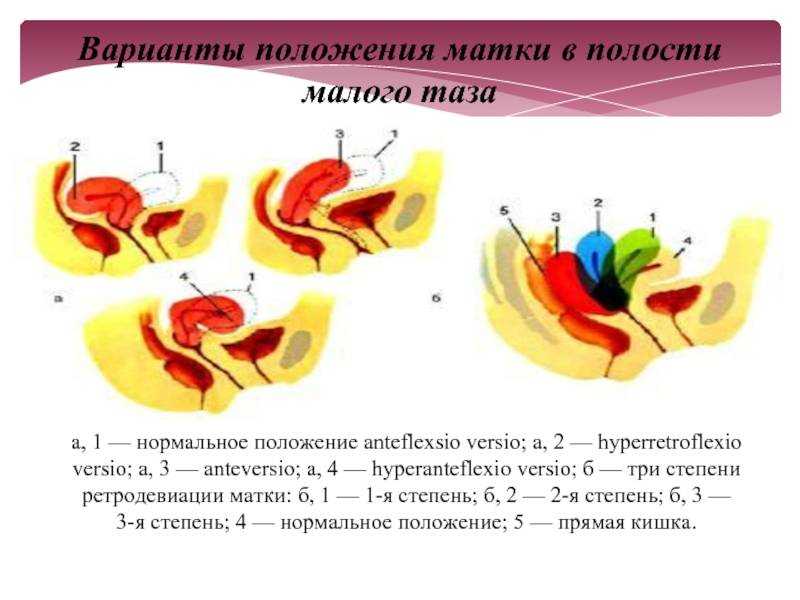 Пролапс матки