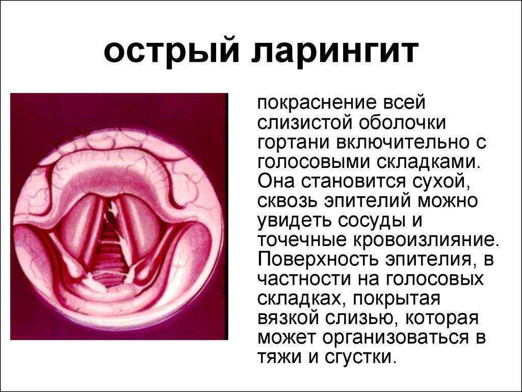 Ларингит: причины и лечение | оралсепт
