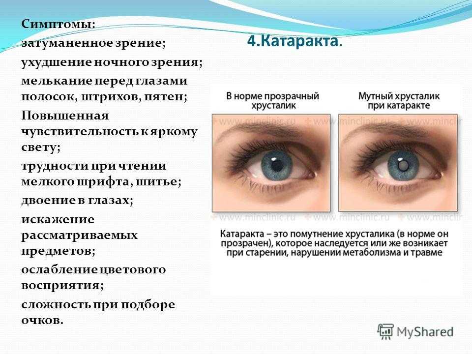 Зрение после беременности. Симптомы ухудшения зрения. Признаки ухудшения зрения. Причины нарушения остроты зрения. Признаки падения зрения.