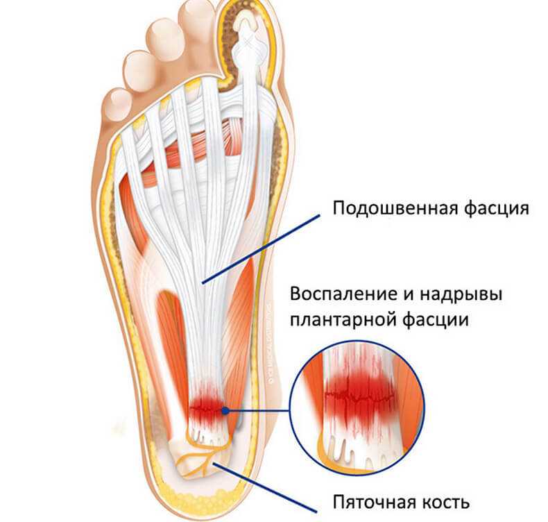 Подошвенный фасциит: о чем вы должны знать - noltrexsin