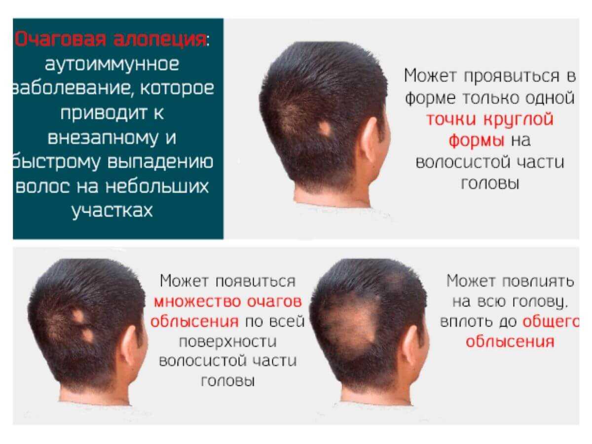 Лечение выпадения волос у женщин – причины облысения, средства против выпадения