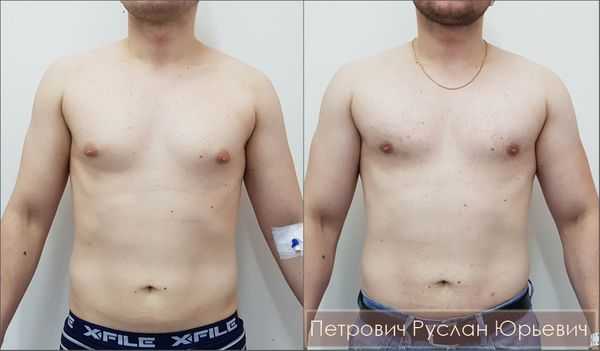 Молочница у женщин, мужчин, причины, симптомы, лечение, как избавиться от молочницы