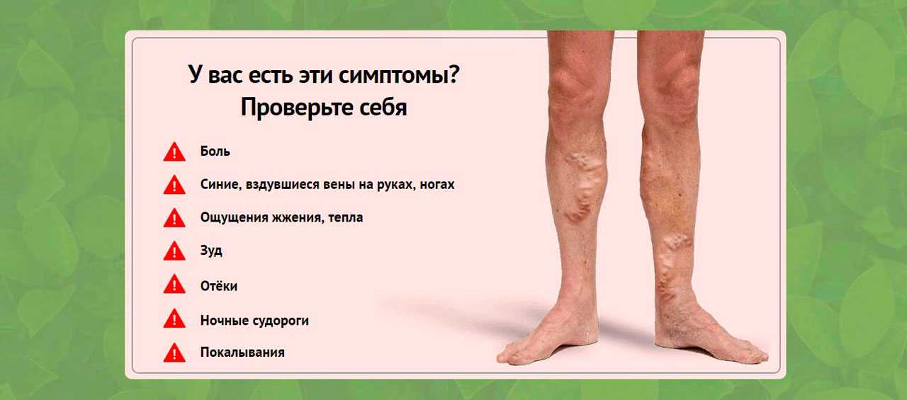 Варикоз при беременности: признаки, причины, лечение и профилактика