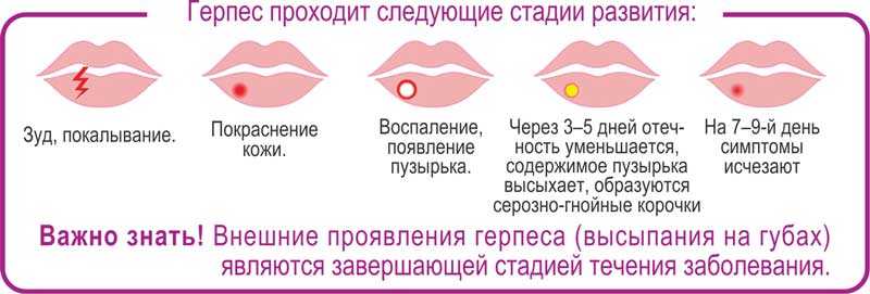Лечение герпеса: как и чем быстро вылечить герпесную инфекцию – поликлиника +1