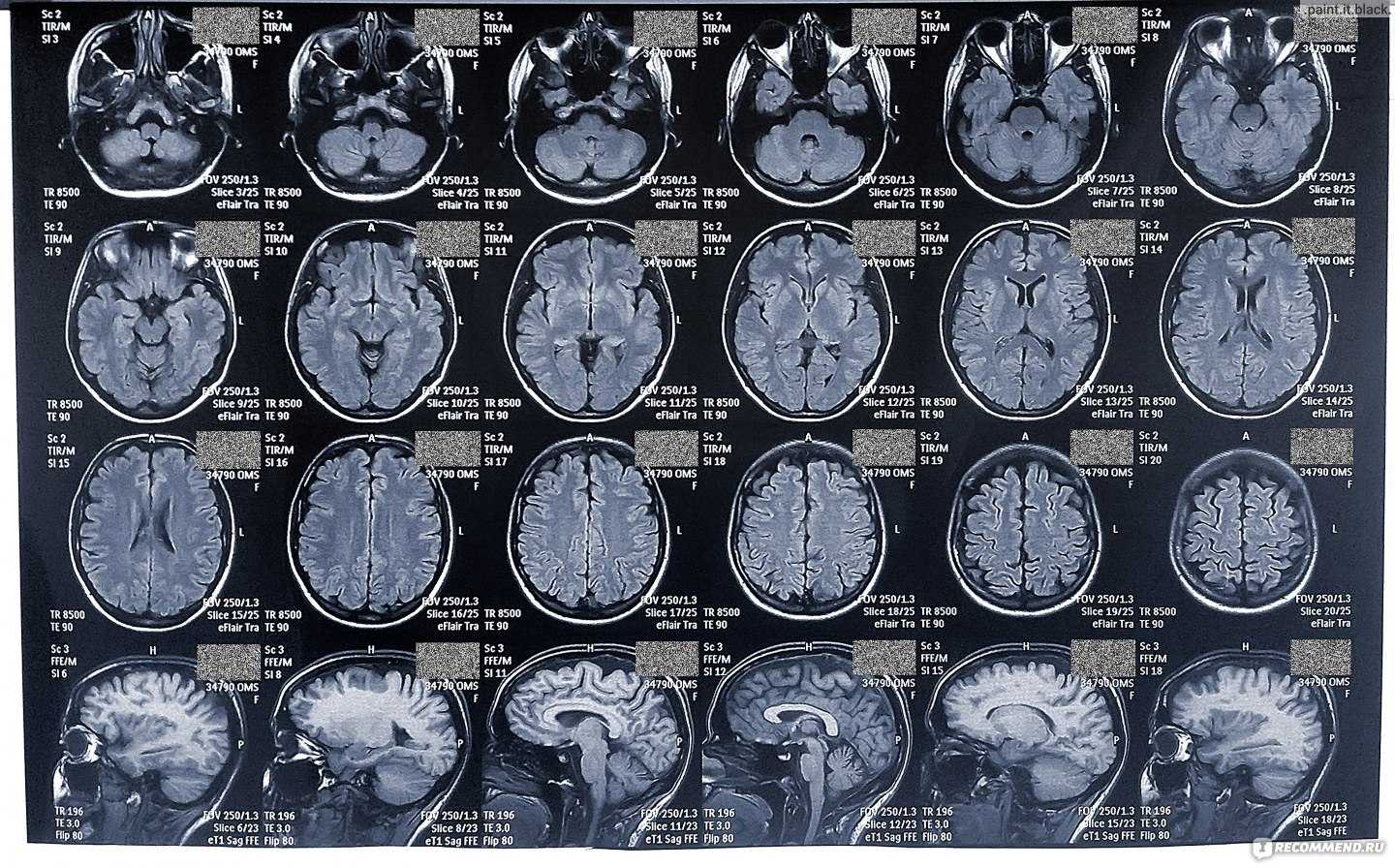 Мрт паническая атака. Магнитная резонансная томография головного мозга. Мрт снимок мозга сбоку. Мрт магнитно-резонансная томография головного мозга. Компьютерная томография кт головного мозга.