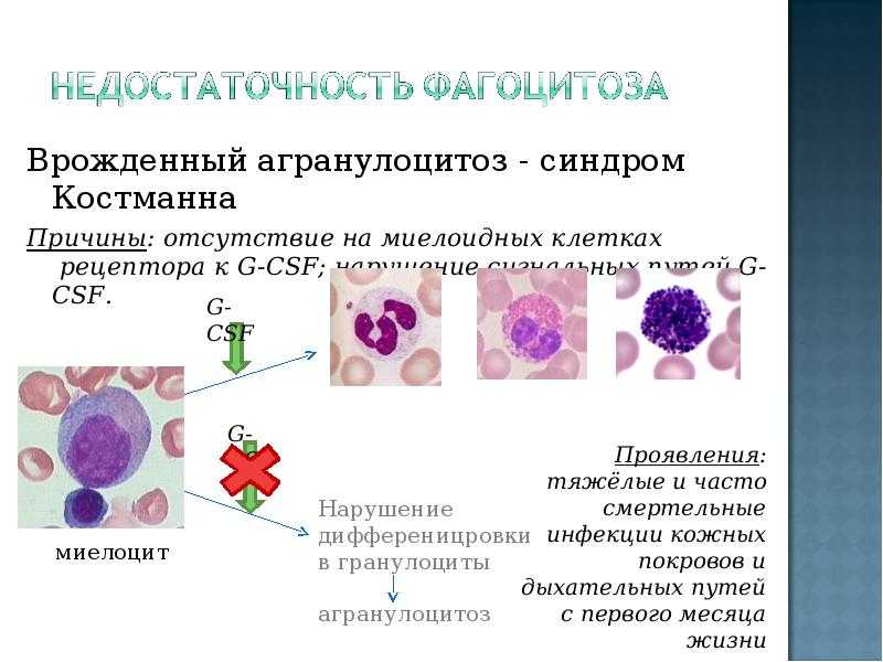 Агранулоцитоз и нейтропения — недостаточность нейтрофилов