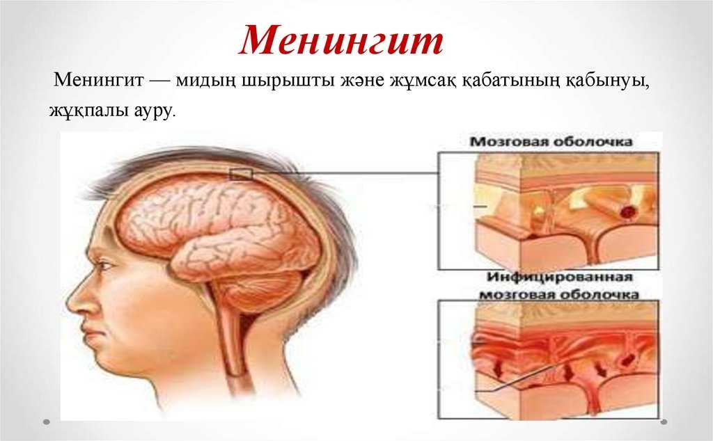 Менингококковая инфекция