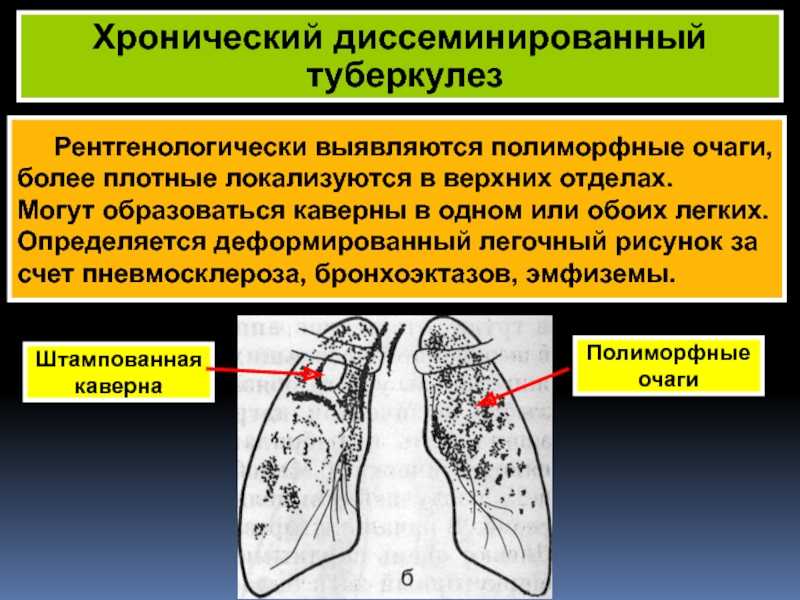 Туберкулёз1 min read