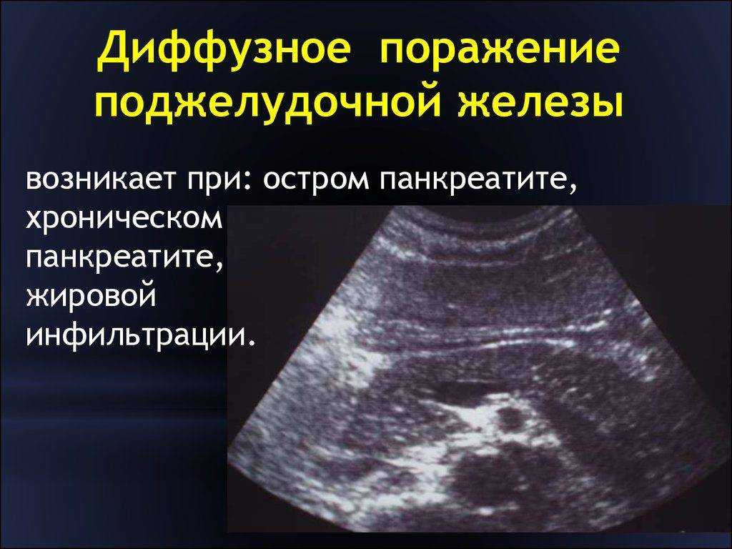 Гепатомегалия печени как лечить - кгбуз горбольница №12
