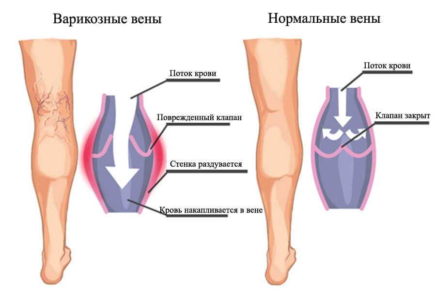 Варикозное расширение вен нижних конечностей