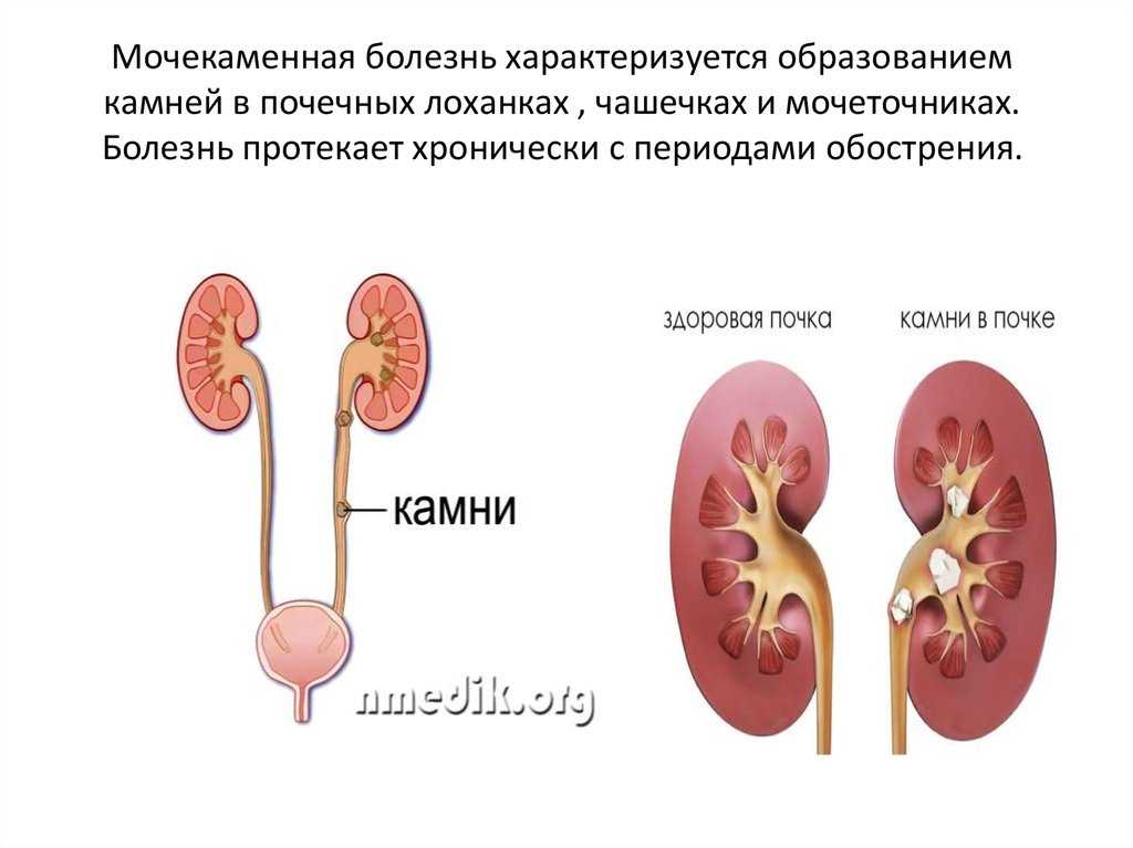 Мочекаменная болезнь — патологию нужно диагностировать и лечить, не дожидаясь приступов почечной колики