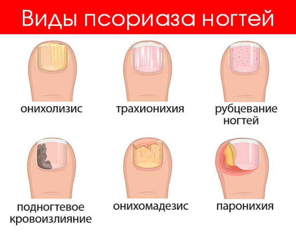 Онихомикоз у пожилых людей