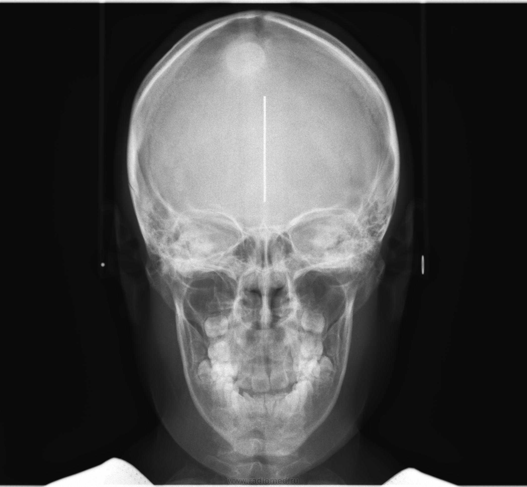 Лоб кость. Остеома костей черепа рентген. Остеома челюсти рентген. Остеома лобной рентген. Рентген черепа в прямой проекции.