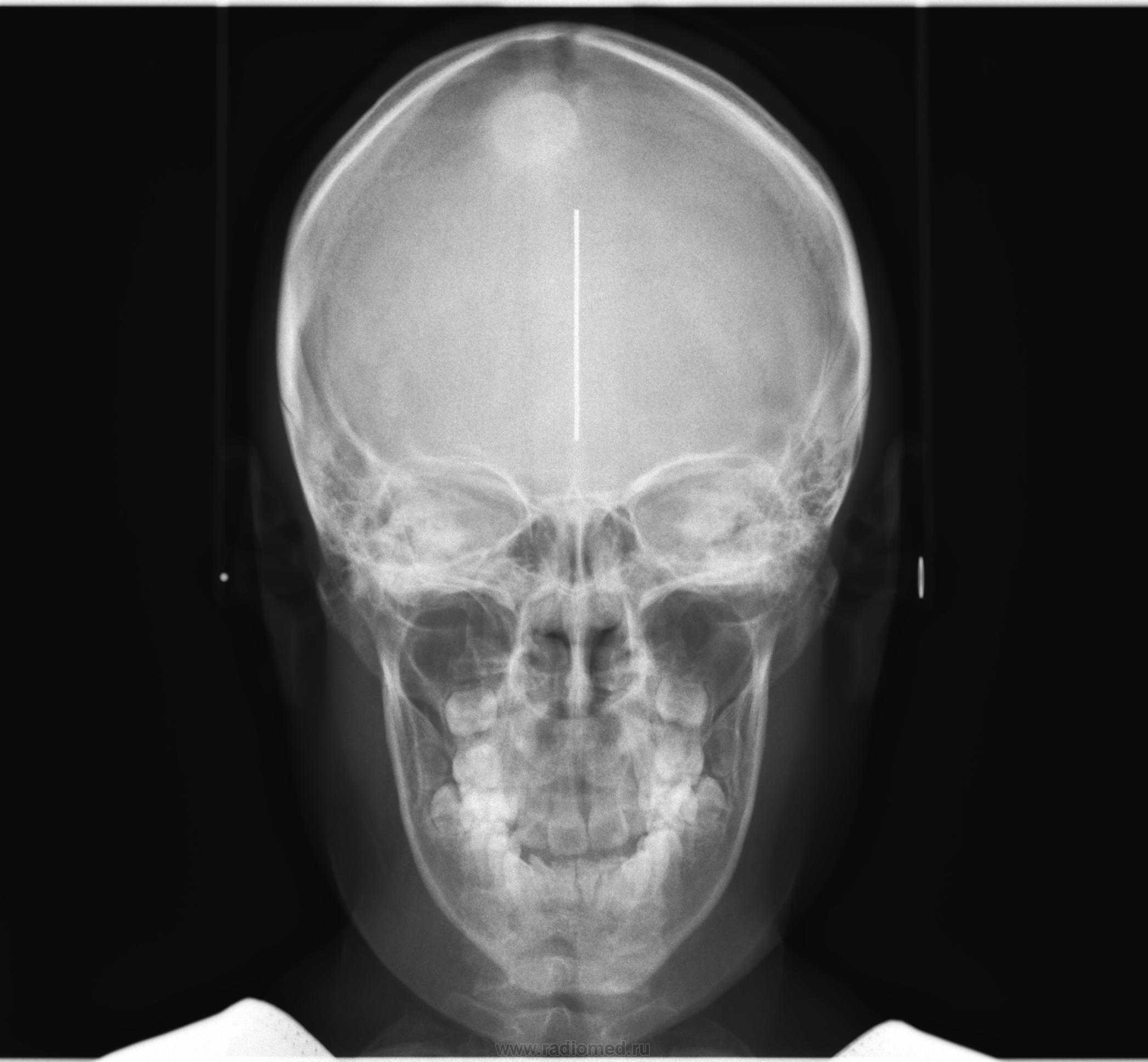Тг снимок. Остеома кости черепа на рентгене. ТРГ носоподбородочная проекция. Остеома затылочной кости черепа кт.