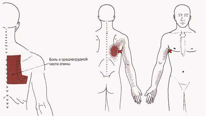 Боль под правой лопаткой сзади со спины: причины боли в правой лопатке