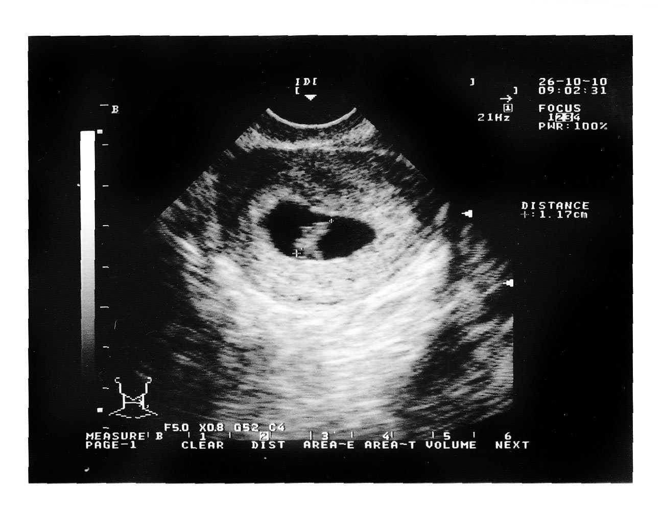 После первого узи. УЗИ при беременности на ранних сроках. УЗИ беременности на ранних сроках 1-2 недели. УЗИ беременности на ранних сроках 1 неделя. Снимок УЗИ беременности на ранних сроках.